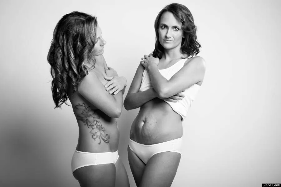 La réalité du corps et ses cicatrices après l'accouchement