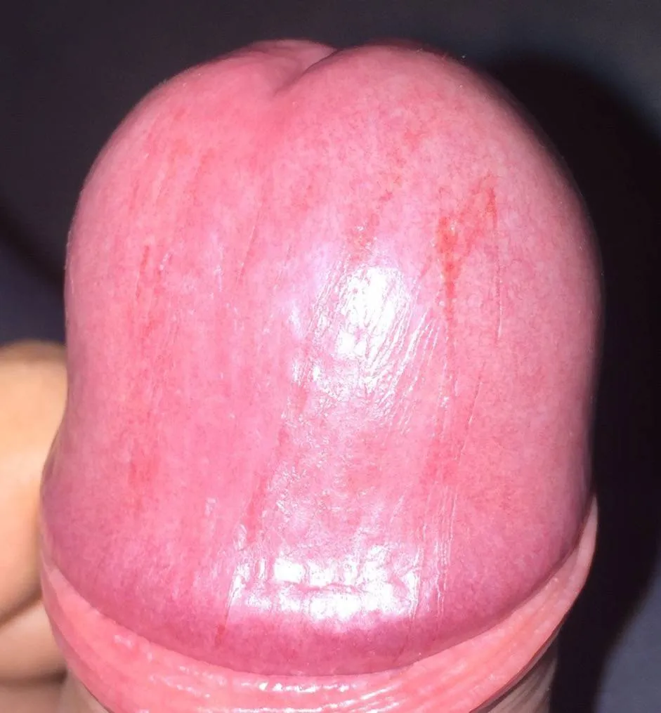 Vue rapprochée d'irritations et de griffures sur le gland causées par un stérilet