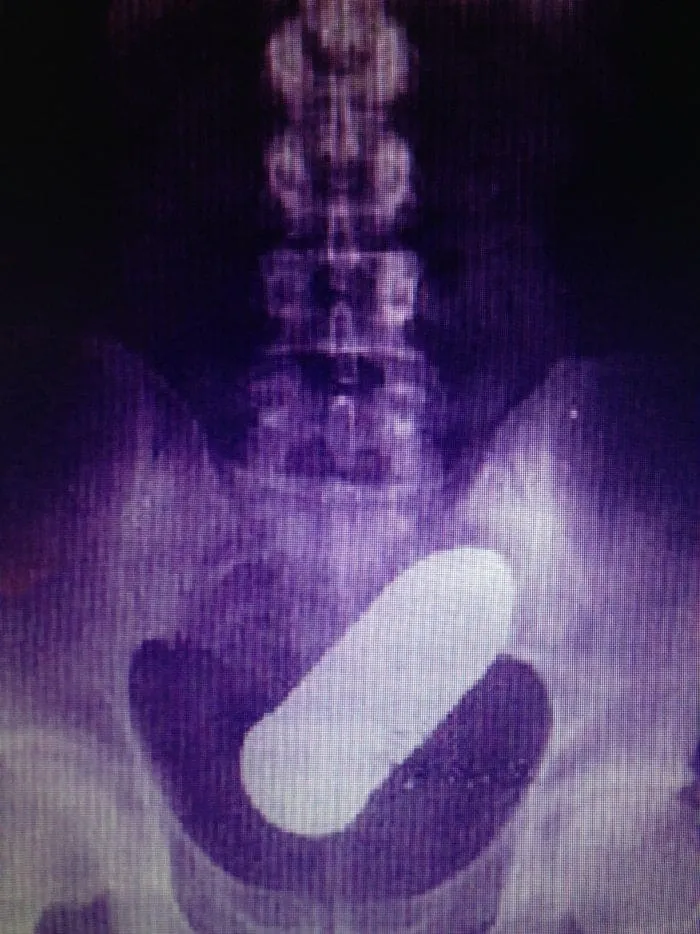 Oups... comment récupérer un plug dans ton cul ? Conseils et gestes de secours