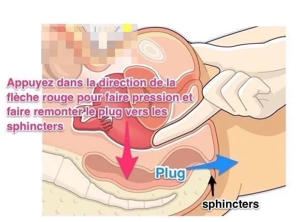 Technique pour sortir un plug