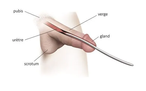 Illustration du principe de la stimulation urétrale