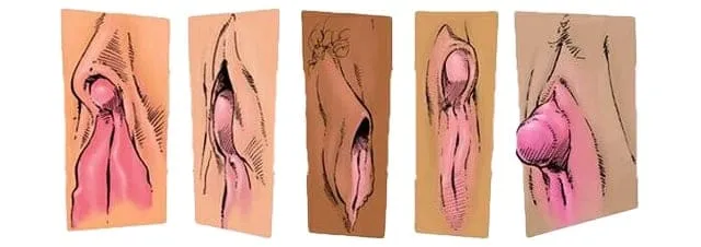 Schéma illustrant les différentes tailles et positionnements du clitoris